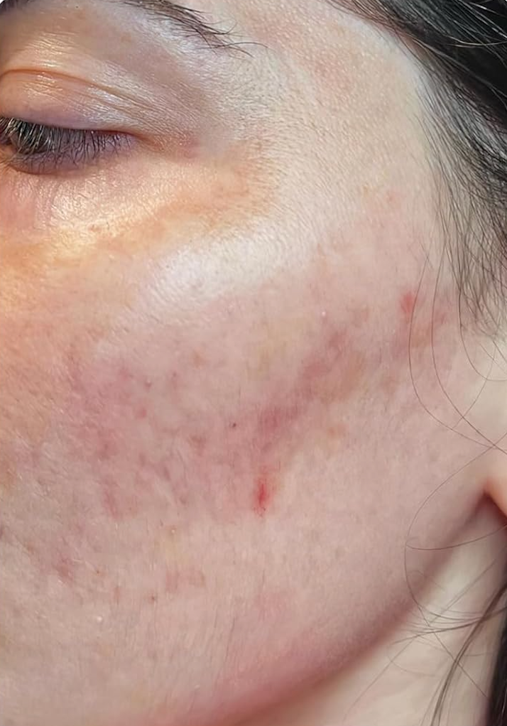 Persona con granos y rosácea en la cara antes de usar el panel de terapia de luz roja 